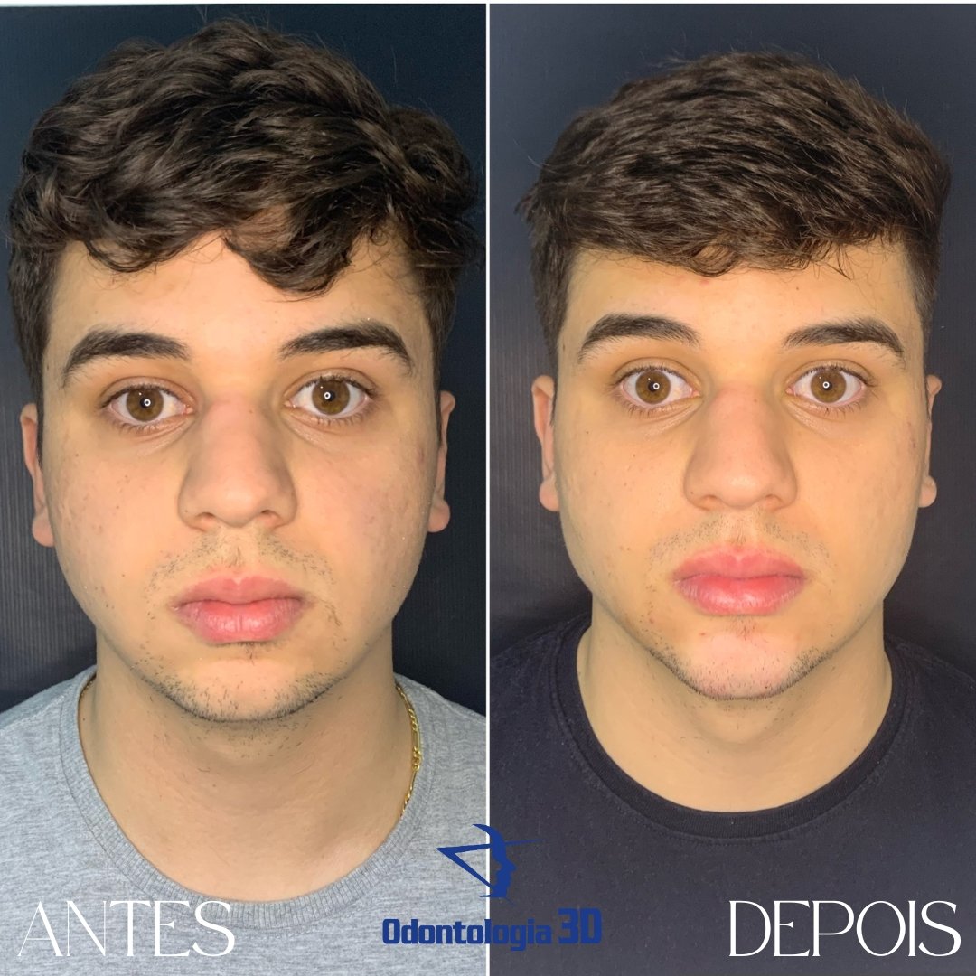 Harmonização Facial